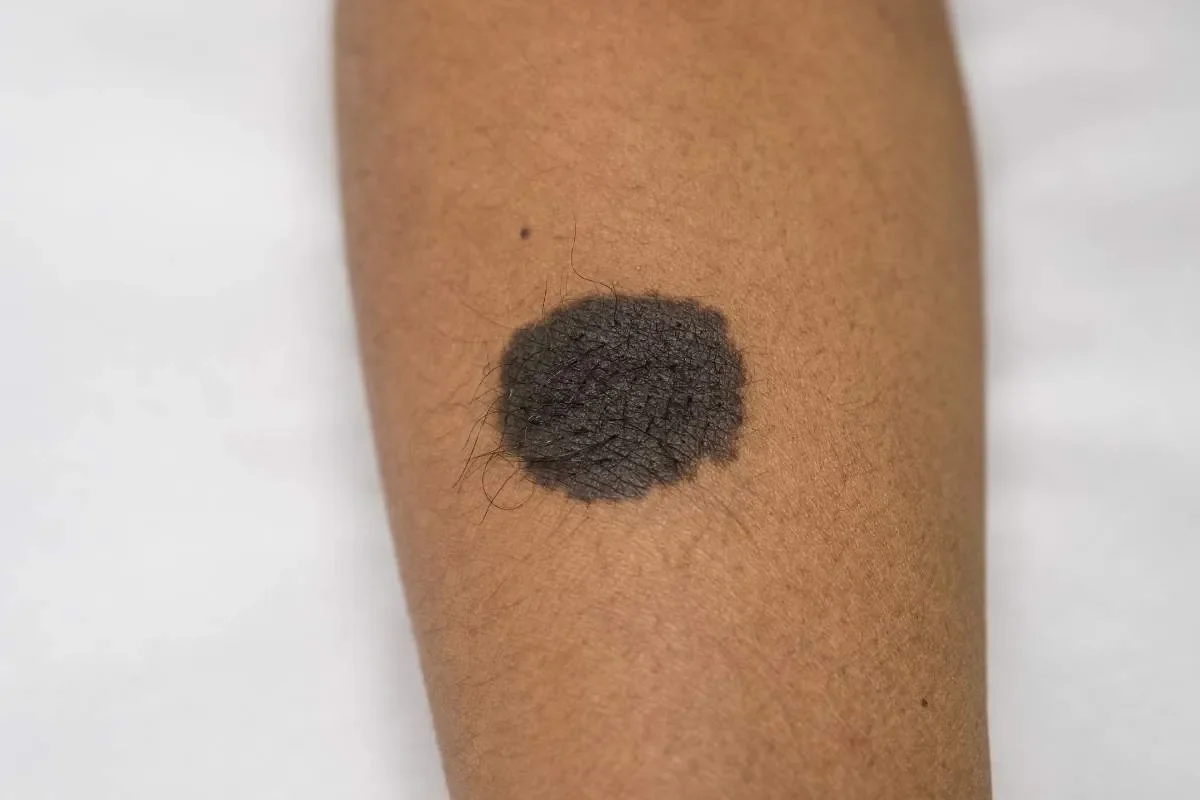 Naevus géant : comprendre cette condition congénitale